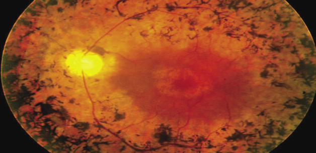 Retinitis pigmentosa - View of the retina in a patient diagnosed with the disease   