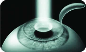 Image of a corneal intervention with laser 3