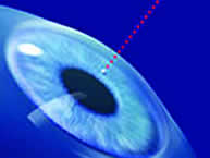 Image of a corneal intervention with laser 1