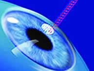 Image of a corneal intervention with laser 2