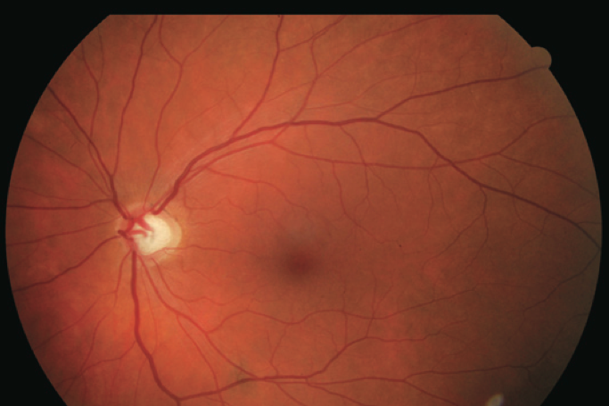 Macular degeneration